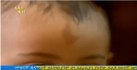 A baby born with Ethiopian Map imprinted on his forhead